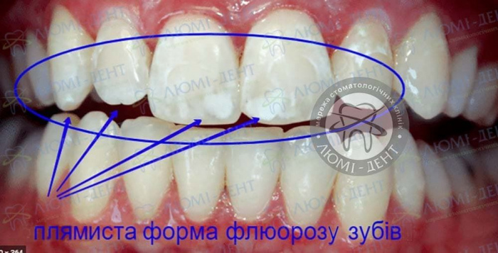 Флюороз емалі зубів фото Люмі-Дент